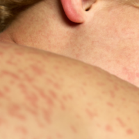 Measles Is Harmful, Contrary to Flimsy Social Media Claims of Long-Term Benefits