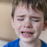 RFK Jr.’s Misleading Line on the Chickenpox Vaccine